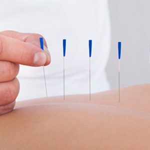 Dry needling and Acupuncture 